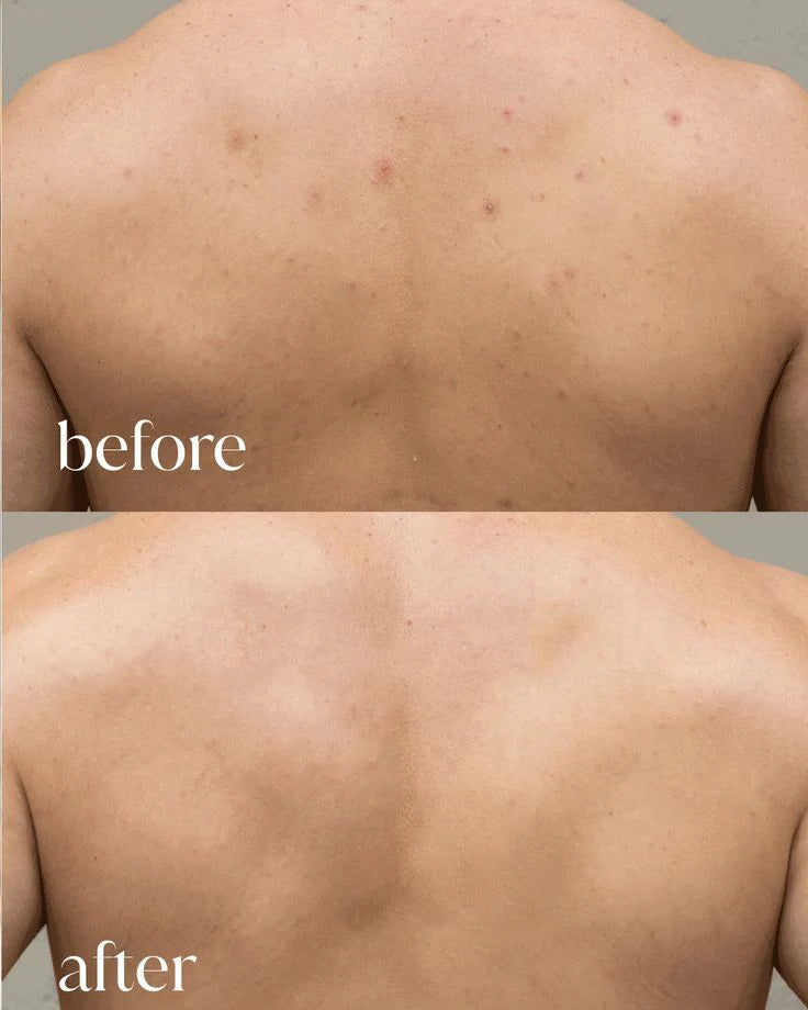 Klivry Peel Shot - Kojic + Turmeric Body Peel Spray