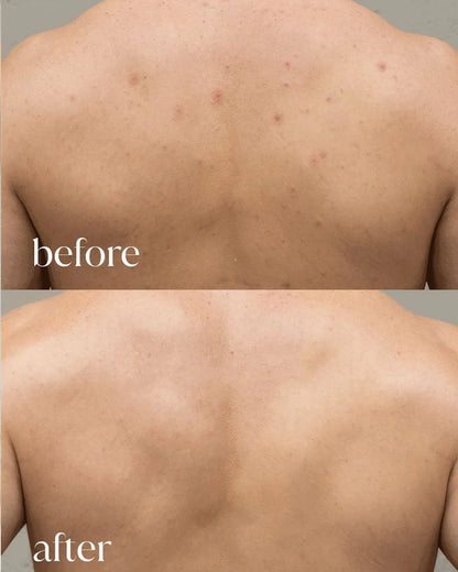 Klivry Peel Shot - Kojic + Turmeric Body Peel Spray